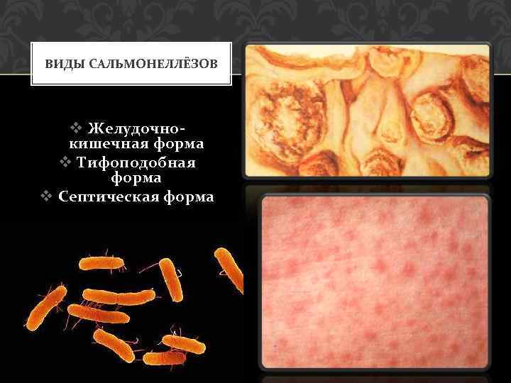 ВИДЫ САЛЬМОНЕЛЛЁЗОВ v Желудочнокишечная форма v Тифоподобная форма v Септическая форма 