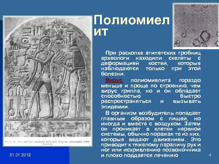 Полиомиел ит 31. 01. 2018 При раскопке египетских гробниц археологи находили скелеты с деформацией