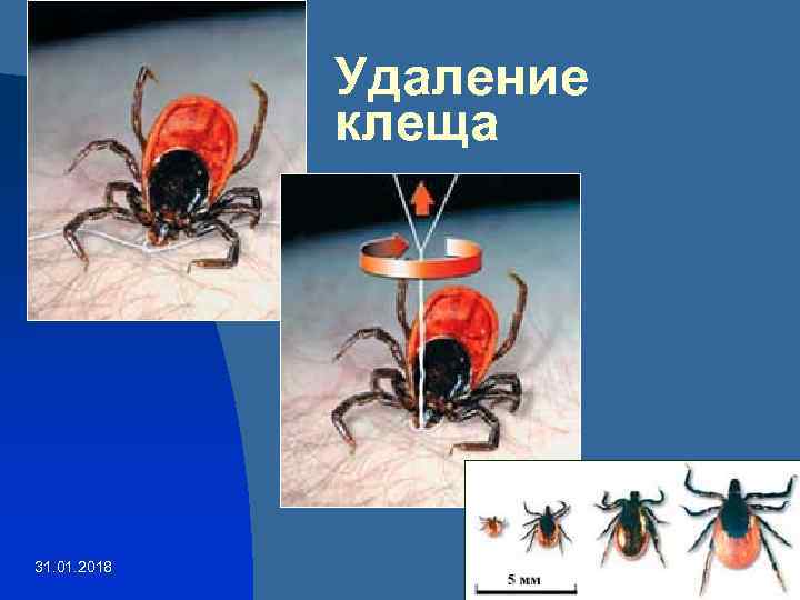 Удаление клеща 31. 01. 2018 6 