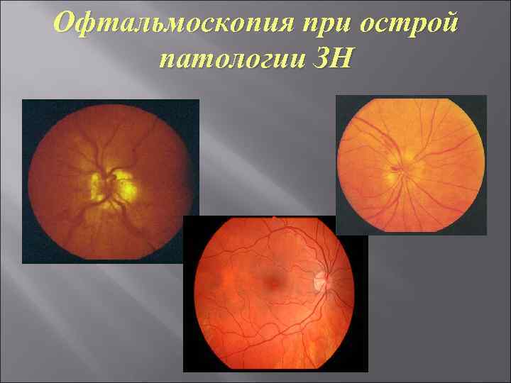 Офтальмоскопия при острой патологии ЗН 