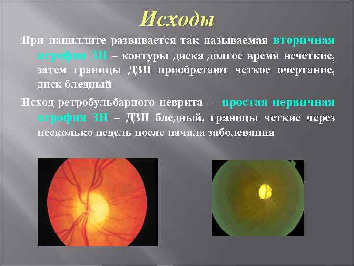 Исходы При папиллите развивается так называемая вторичная атрофия ЗН – контуры диска долгое время