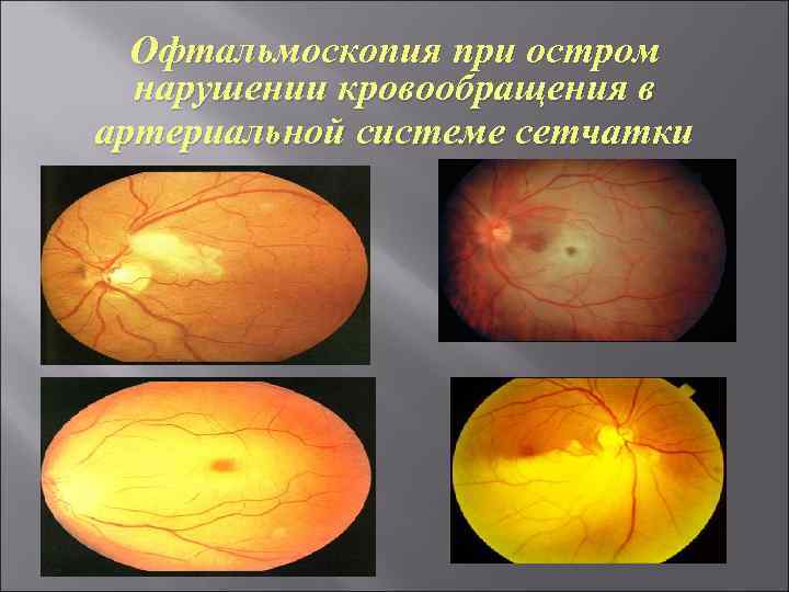 Офтальмоскопия при остром нарушении кровообращения в артериальной системе сетчатки 