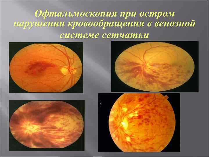 Офтальмоскопия линзой. Офтальмоскопия глазного дна. Непрямая офтальмоскопия глазного дна. Офтальмоскопия сетчатки. Зубчатая линия сетчатки офтальмоскопия.