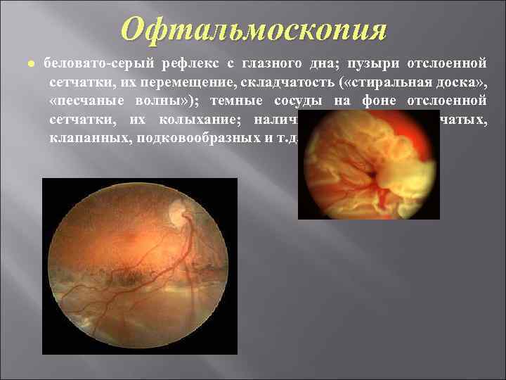 Офтальмоскопия ● беловато-серый рефлекс с глазного дна; пузыри отслоенной сетчатки, их перемещение, складчатость (