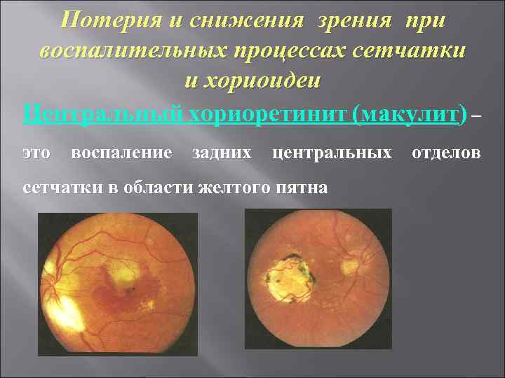 Потерия и снижения зрения при воспалительных процессах сетчатки и хориоидеи Центральный хориоретинит (макулит) –
