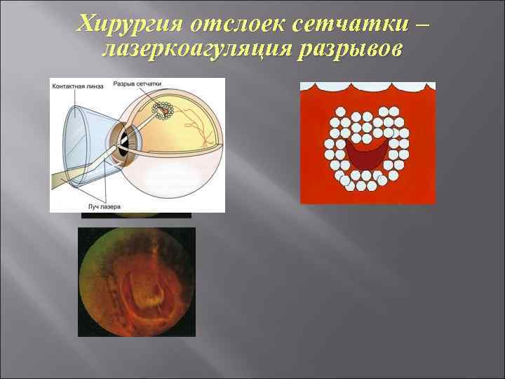 Хирургия отслоек сетчатки – лазеркоагуляция разрывов 