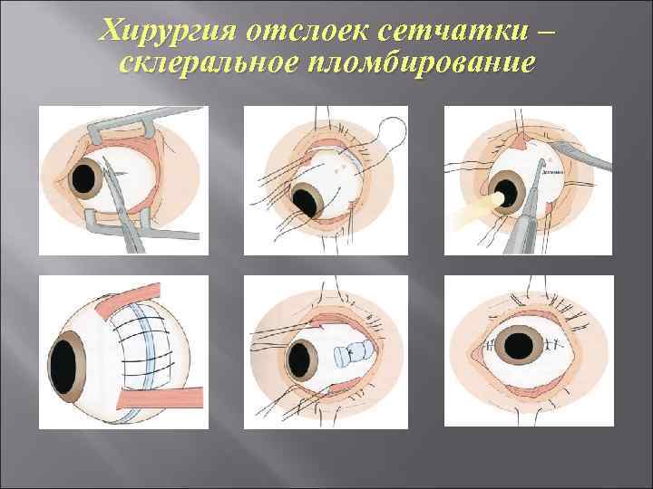 Хирургия отслоек сетчатки – склеральное пломбирование 