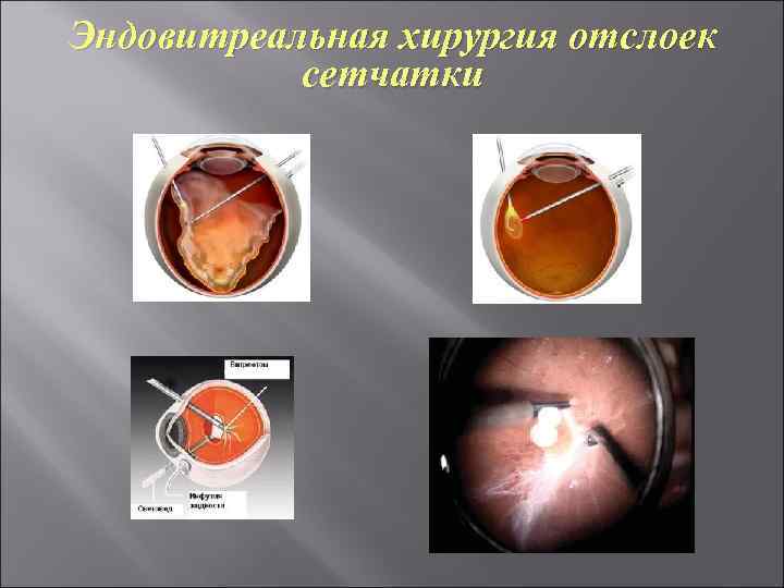 Эндовитреальная хирургия отслоек сетчатки 