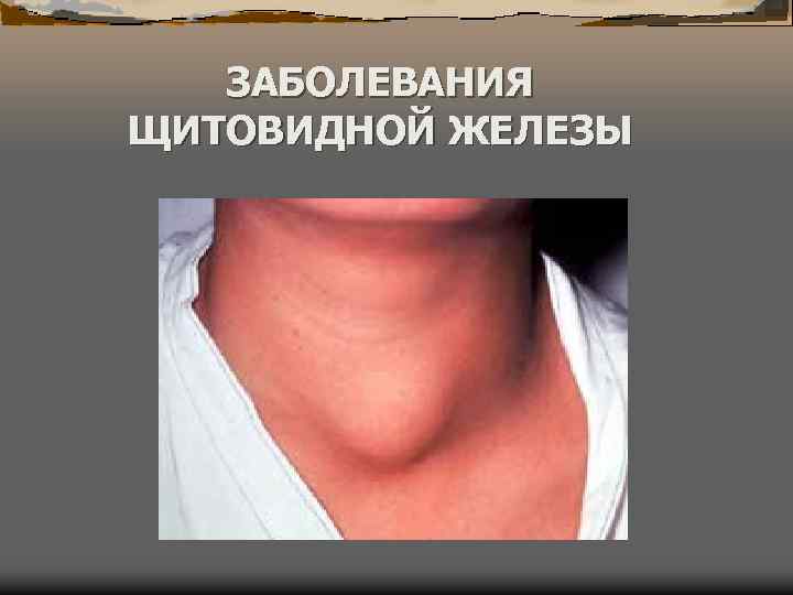 Где щитовидная железа фото у мужчин