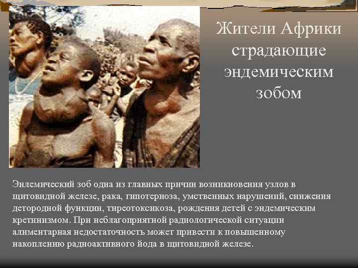 Жители Африки страдающие эндемическим зобом Энлемический зоб одна из главных причин возникновения узлов в