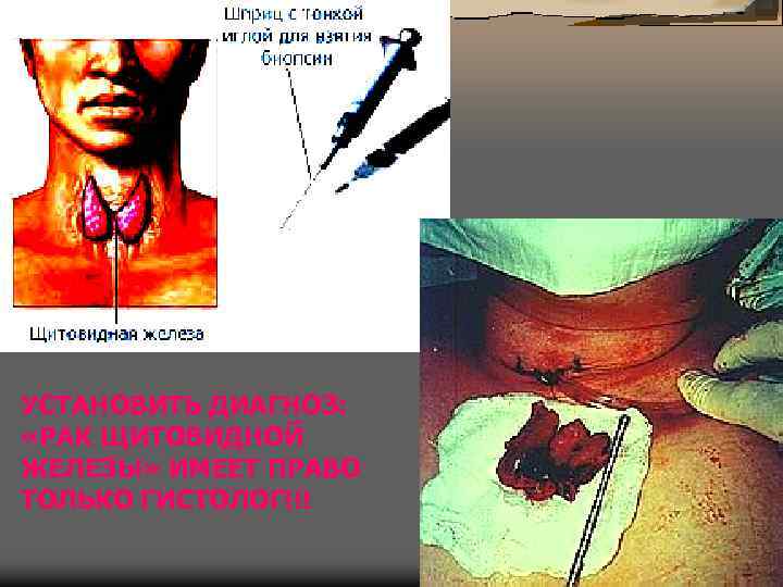 УСТАНОВИТЬ ДИАГНОЗ: «РАК ЩИТОВИДНОЙ ЖЕЛЕЗЫ» ИМЕЕТ ПРАВО ТОЛЬКО ГИСТОЛОГ!!! 