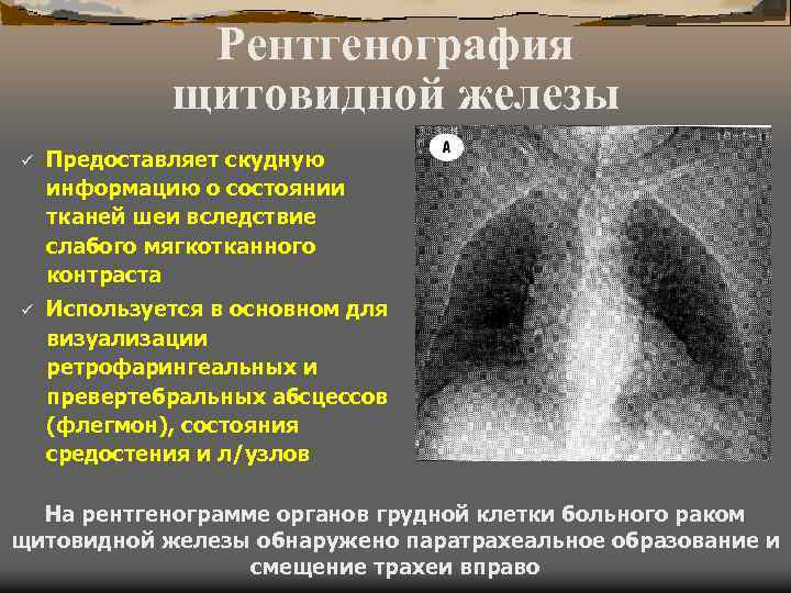 Диффузное обследование. Рентген исследование щитовидной железы. Методика лучевой диагностики щитовидной железы. Рентгенодиагностика щитовидной железы. Методы лучевой диагностики заболеваний щитовидной железы.