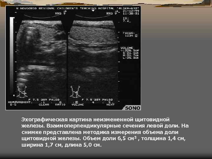 Эхографические признаки стенозирующего