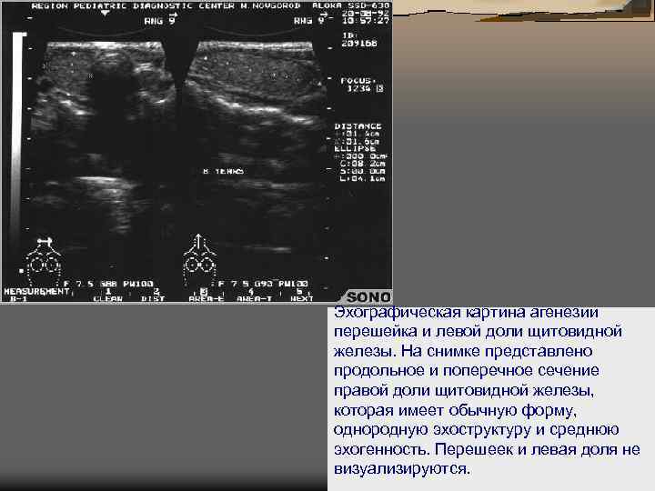 Эхографическая картина агенезии перешейка и левой доли щитовидной железы. На снимке представлено продольное и