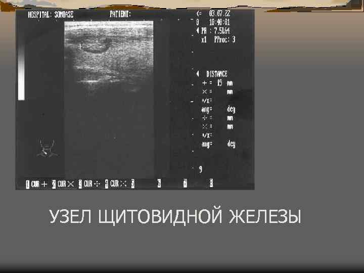 УЗЕЛ ЩИТОВИДНОЙ ЖЕЛЕЗЫ 