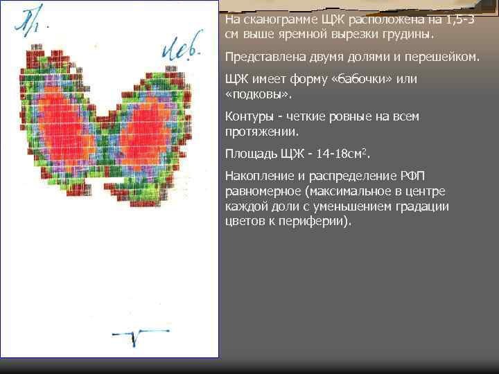 На сканограмме ЩЖ расположена на 1, 5 -3 см выше яремной вырезки грудины. Представлена