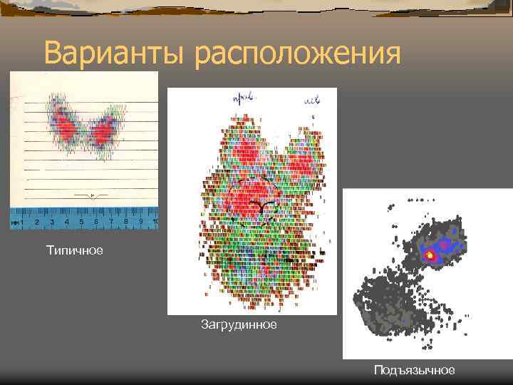 Варианты расположения Типичное Загрудинное Подъязычное 