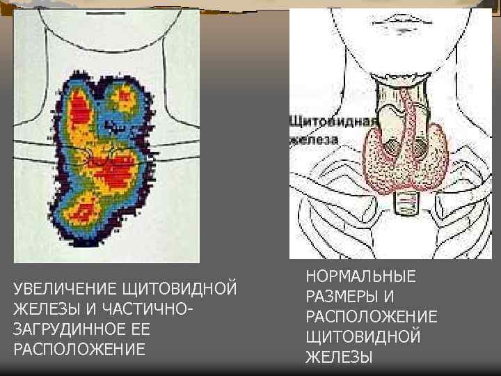 УВЕЛИЧЕНИЕ ЩИТОВИДНОЙ ЖЕЛЕЗЫ И ЧАСТИЧНОЗАГРУДИННОЕ ЕЕ РАСПОЛОЖЕНИЕ НОРМАЛЬНЫЕ РАЗМЕРЫ И РАСПОЛОЖЕНИЕ ЩИТОВИДНОЙ ЖЕЛЕЗЫ 