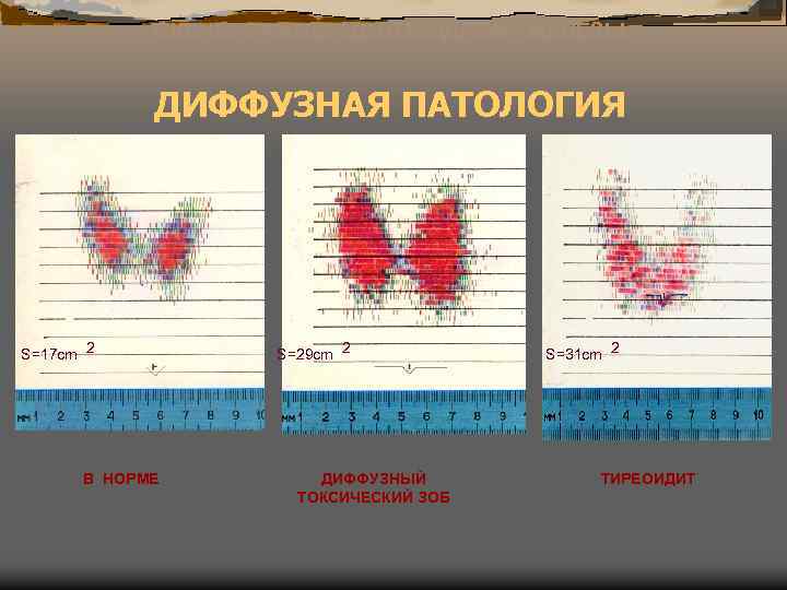 СКАНОГРАММЫ ЩИТОВИДНОЙ ЖЕЛЕЗЫ ДИФФУЗНАЯ ПАТОЛОГИЯ S=17 cm 2 В НОРМЕ S=29 cm 2 ДИФФУЗНЫЙ