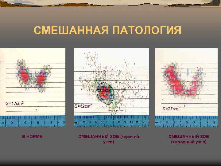 СКАНОГРАММЫ ЩИТОВИДНОЙ ЖЕЛЕЗЫ СМЕШАННАЯ ПАТОЛОГИЯ S=17 cm 2 S=62 cm 2 S=27 cm 2