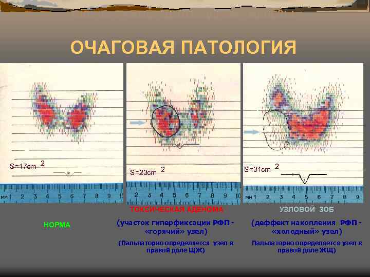 СКАНОГРАММЫ ЩИТОВИДНОЙ ЖЕЛЕЗЫ ОЧАГОВАЯ ПАТОЛОГИЯ S=17 cm 2 S=23 cm 2 S=31 cm 2
