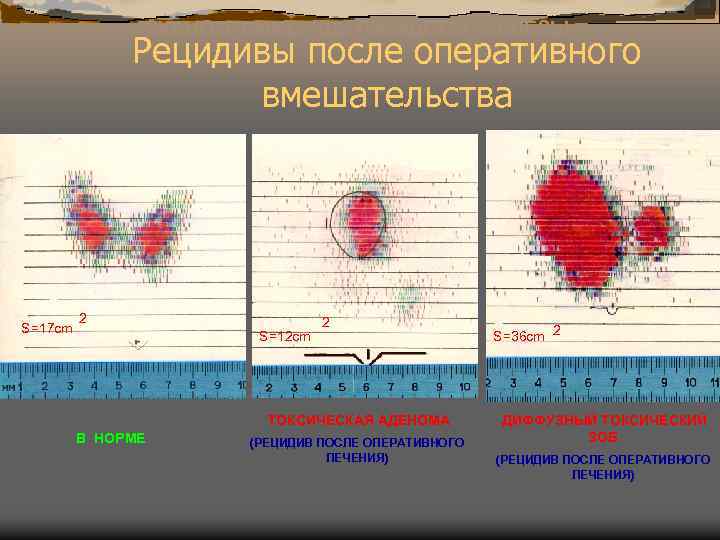 СКАНОГРАММЫ ЩИТОВИДНОЙ ЖЕЛЕЗЫ Рецидивы после оперативного вмешательства S=17 cm 2 S=12 cm 2 ТОКСИЧЕСКАЯ