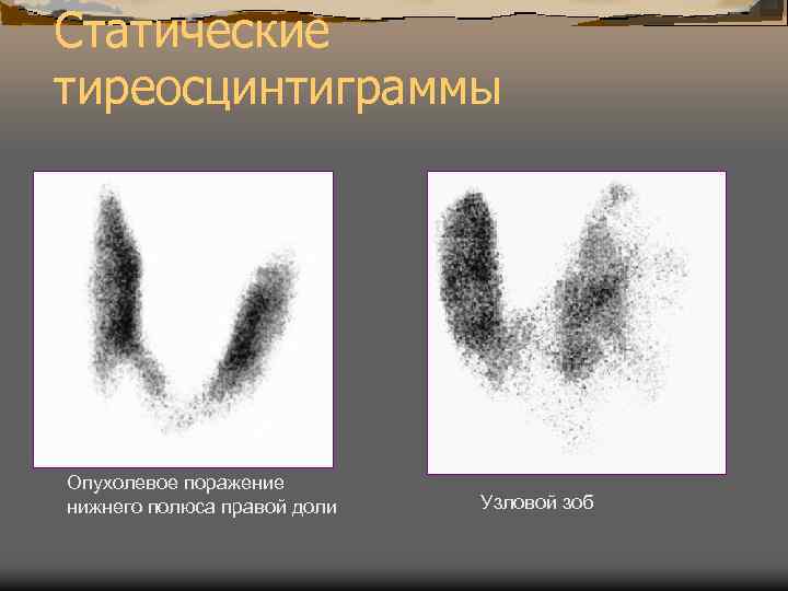 Статические тиреосцинтиграммы Опухолевое поражение нижнего полюса правой доли Узловой зоб 