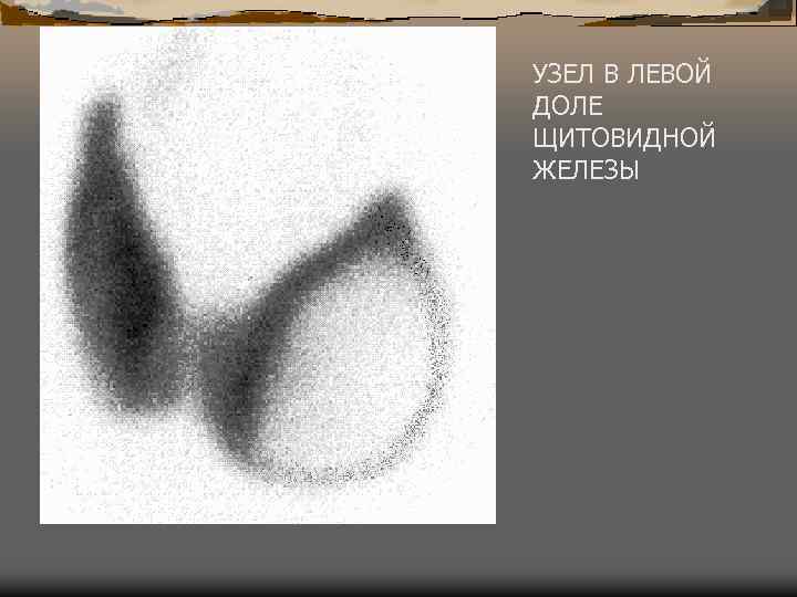 УЗЕЛ В ЛЕВОЙ ДОЛЕ ЩИТОВИДНОЙ ЖЕЛЕЗЫ 