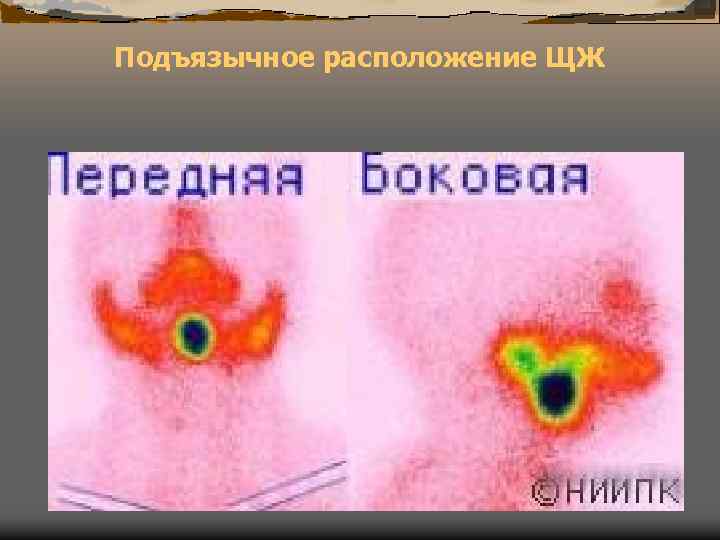 Подъязычное расположение ЩЖ 
