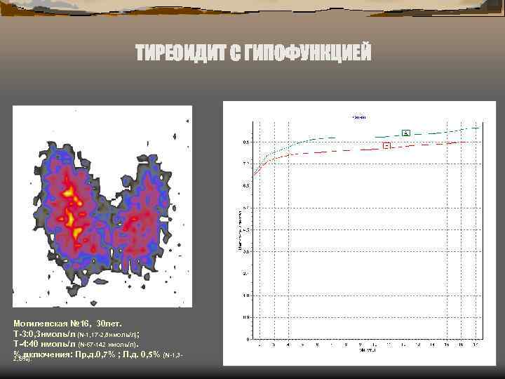 ТИРЕОИДИТ С ГИПОФУНКЦИЕЙ Могилевская № 16, 30 лет. Т-3: 0, 3 нмоль/л (N-1, 17