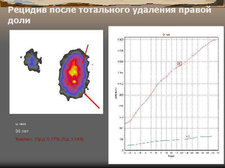 Рецидив после тотального удаления правой доли Ш. № 65, 36 лет %включ. : Пр.