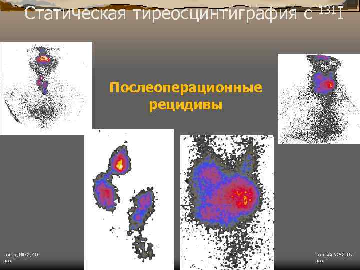 Статическая тиреосцинтиграфия с 131 I Послеоперационные рецидивы Голад № 72, 49 лет Топчий №