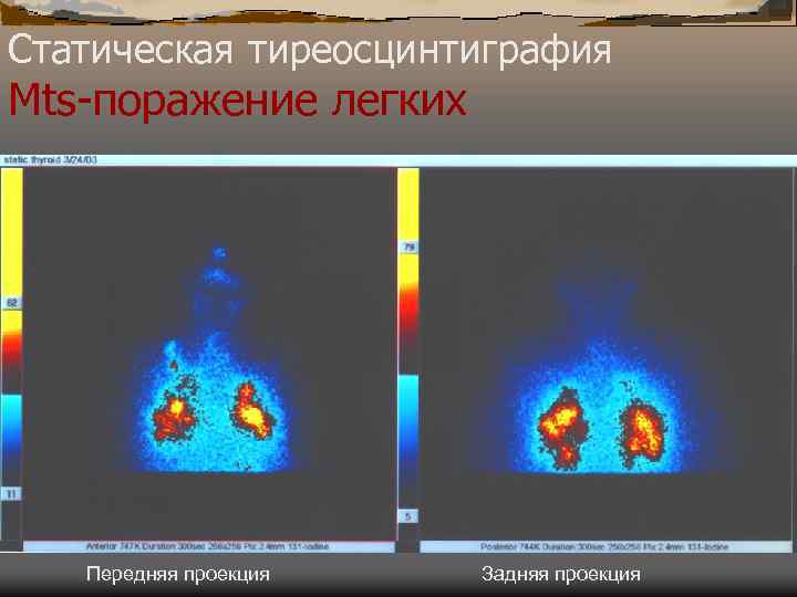 Статическая тиреосцинтиграфия Mts-поражение легких Передняя проекция Задняя проекция 