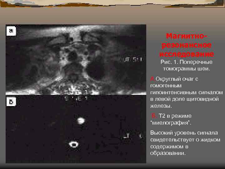 Магнитнорезонансное исследование Рис. 1. Поперечные томограммы шеи. А. Округлый очаг с гомогенным гипоинтенсивным сигналом