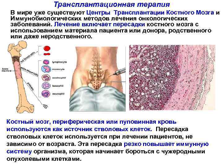 Трансплантационная терапия В мире уже существуют Центры Трансплантации Костного Мозга и Иммунобиологических методов лечения