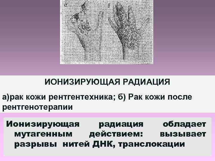 ИОНИЗИРУЮЩАЯ РАДИАЦИЯ а)рак кожи рентгентехника; б) Рак кожи после рентгенотерапии Ионизирующая радиация обладает мутагенным
