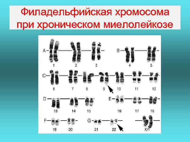 Филадельфийская хромосома при хроническом миелолейкозе 