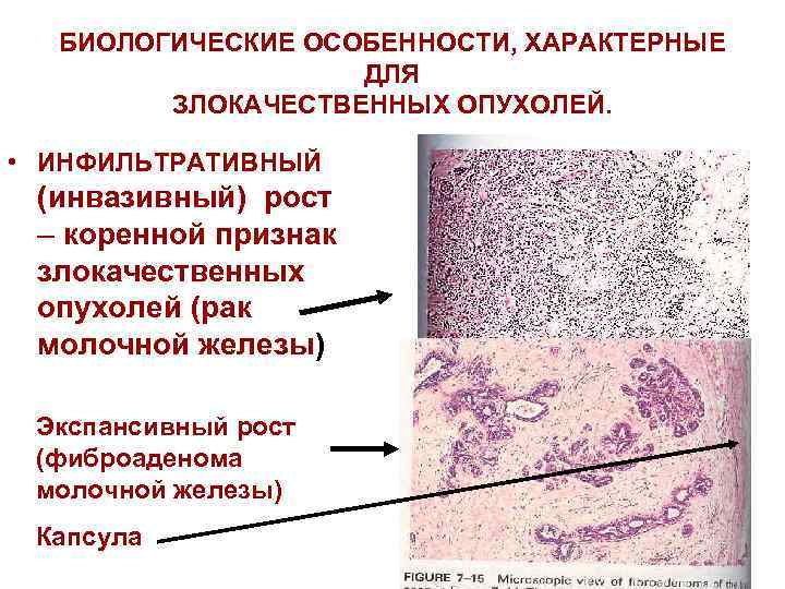 БИОЛОГИЧЕСКИЕ ОСОБЕННОСТИ, ХАРАКТЕРНЫЕ ДЛЯ ЗЛОКАЧЕСТВЕННЫХ ОПУХОЛЕЙ. • ИНФИЛЬТРАТИВНЫЙ (инвазивный) рост – коренной признак злокачественных