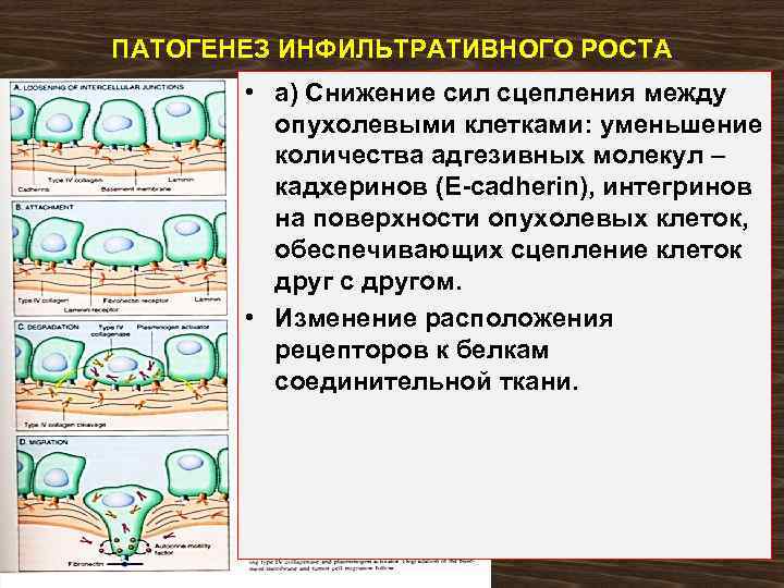 ПАТОГЕНЕЗ ИНФИЛЬТРАТИВНОГО РОСТА • а) Снижение сил сцепления между опухолевыми клетками: уменьшение количества адгезивных