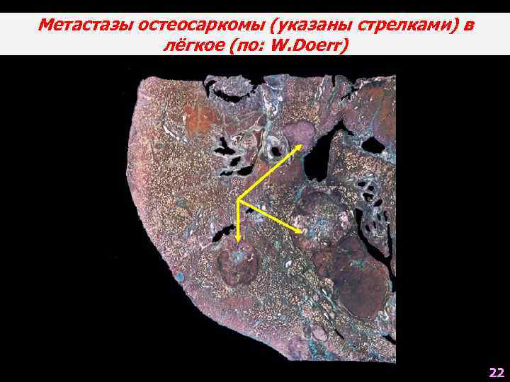 Метастазы остеосаркомы (указаны стрелками) в лёгкое (по: W. Doerr) 22 