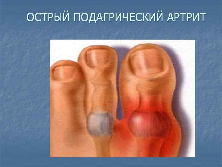 ОСТРЫЙ ПОДАГРИЧЕСКИЙ АРТРИТ 