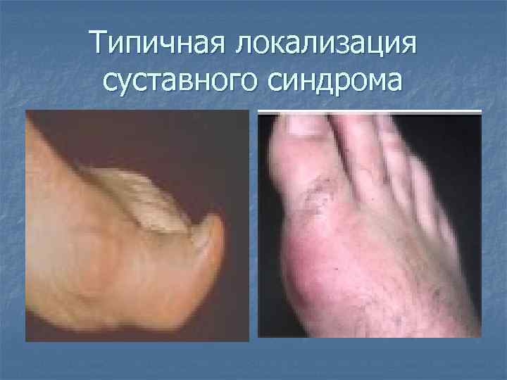 Типичная локализация суставного синдрома 