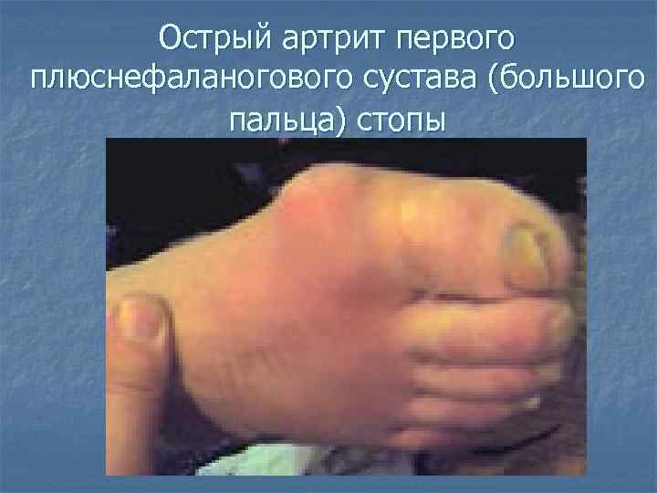 Острый артрит первого плюснефаланогового сустава (большого пальца) стопы 