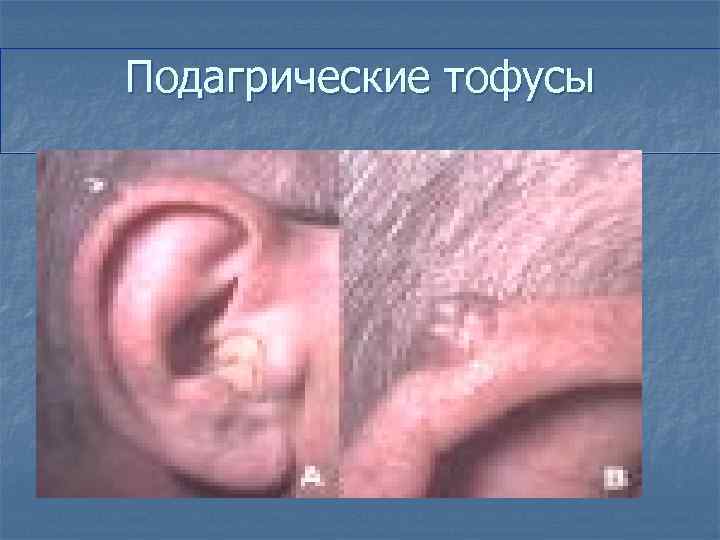 Подагрические тофусы 