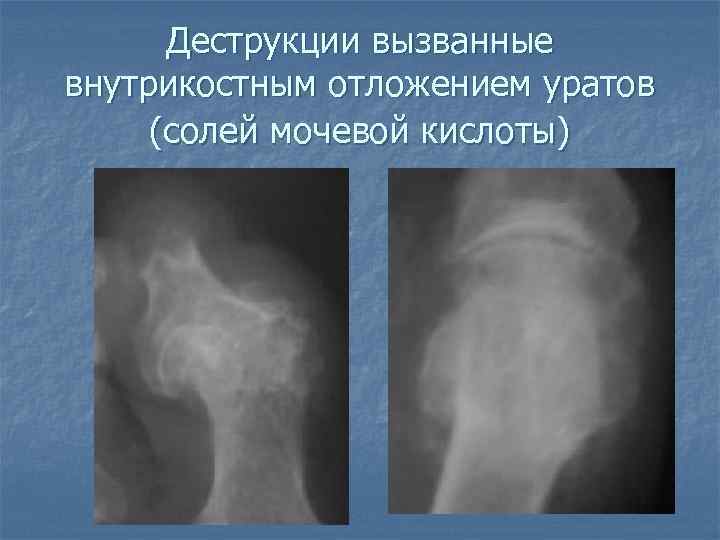 Деструкции вызванные внутрикостным отложением уратов (солей мочевой кислоты) 