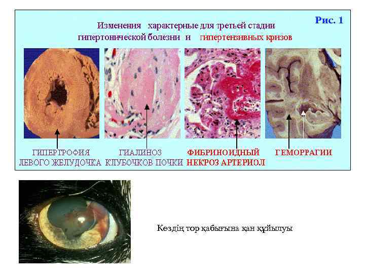 Көздің тор қабығына қан құйылуы 