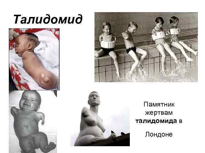 Талидомид Памятник жертвам талидомида в Лондоне 