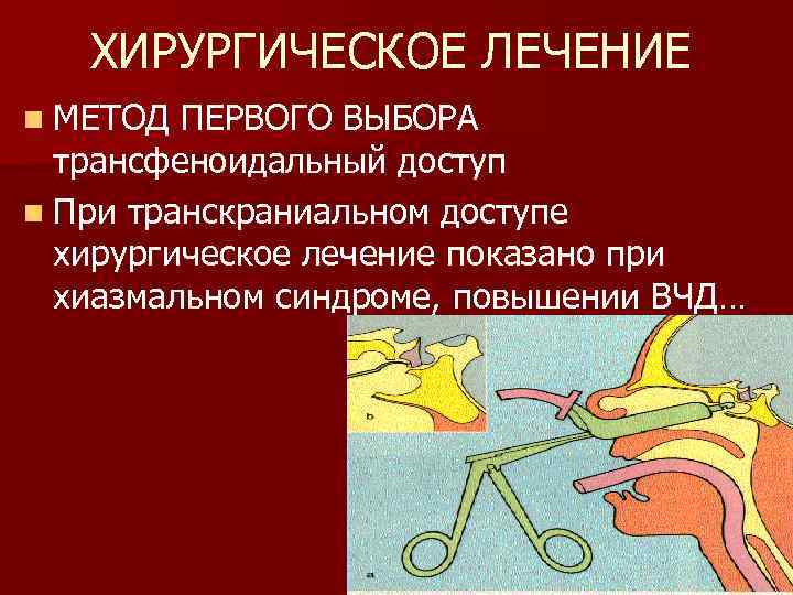 ХИРУРГИЧЕСКОЕ ЛЕЧЕНИЕ n МЕТОД ПЕРВОГО ВЫБОРА трансфеноидальный доступ n При транскраниальном доступе хирургическое лечение