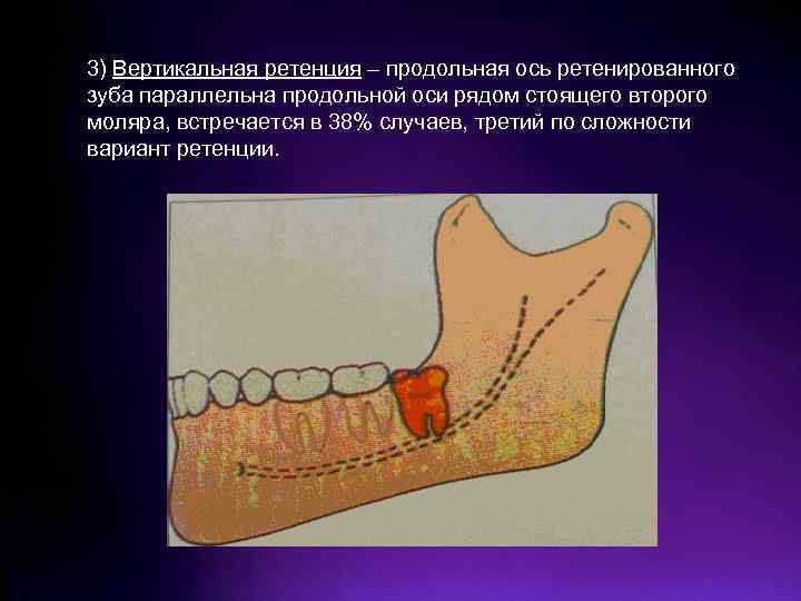 Болезни прорезывания зубов затрудненное прорезывание третьего нижнего моляра презентация