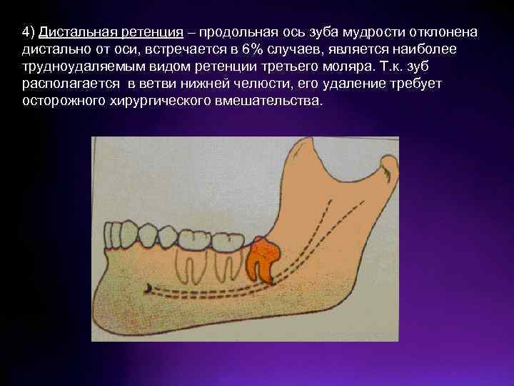 Болезни прорезывания зубов затрудненное прорезывание третьего нижнего моляра презентация